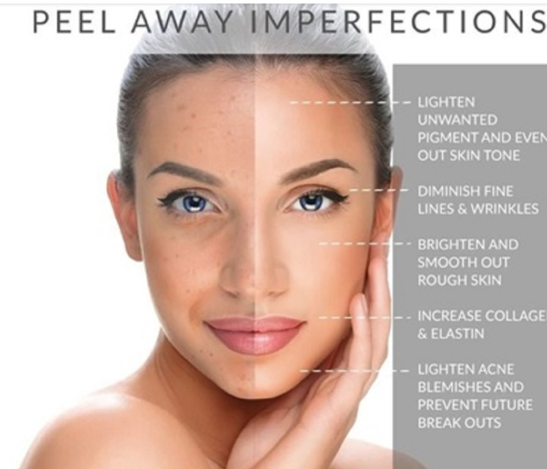 Chemical peel