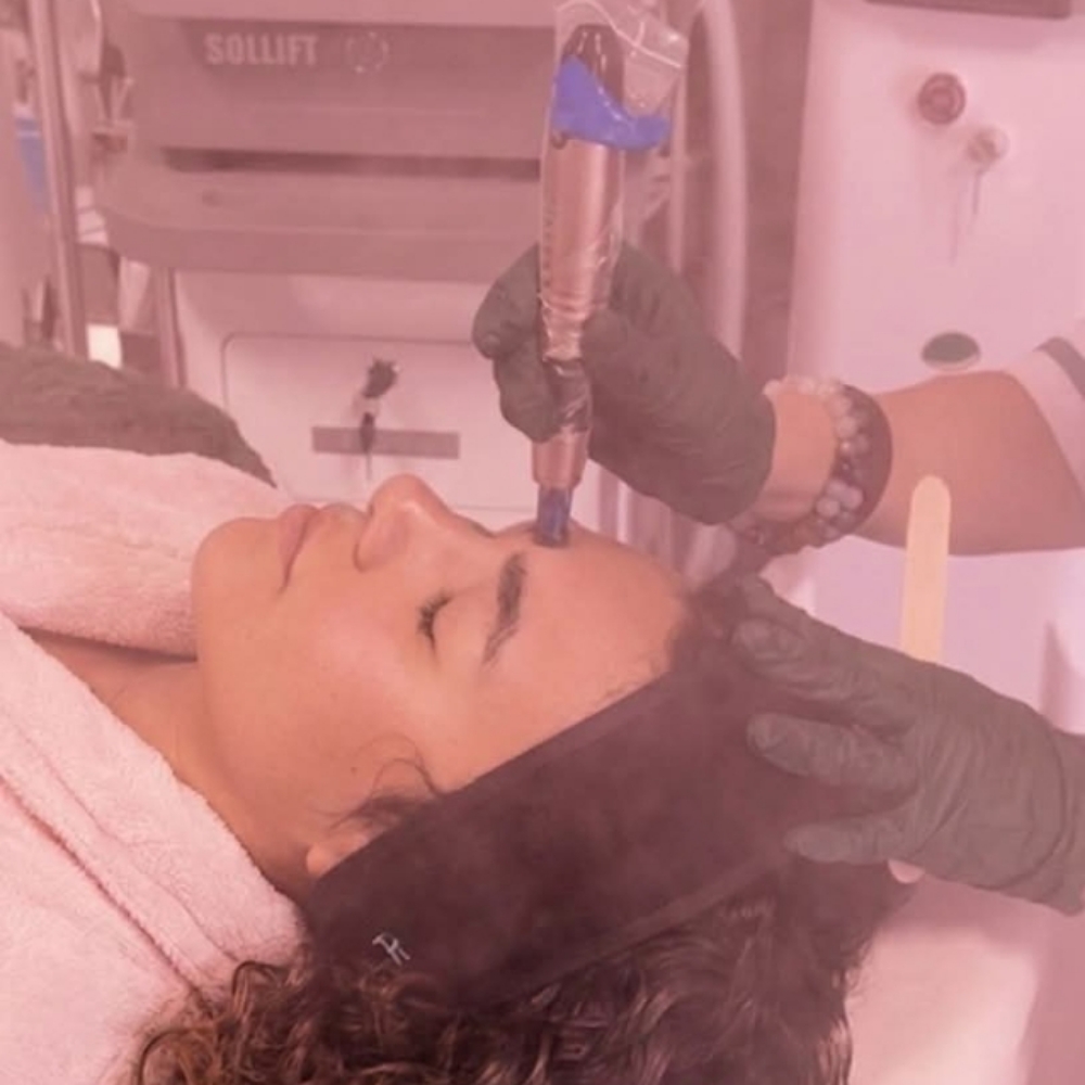 Microneedling at Studio Eleven in Midland, TX