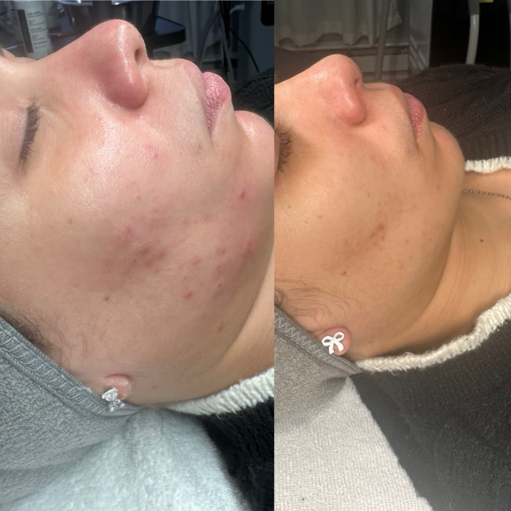 ACNE TREATMENT