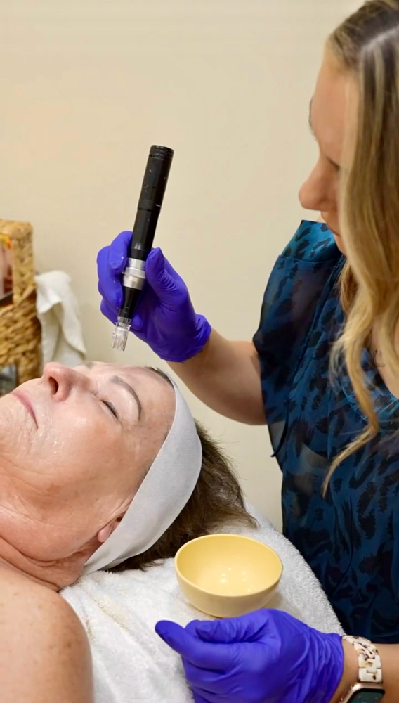 Microneedling Renewal Treatment