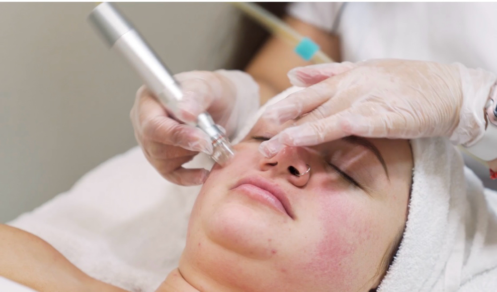 Hydrodermabrasion Facial