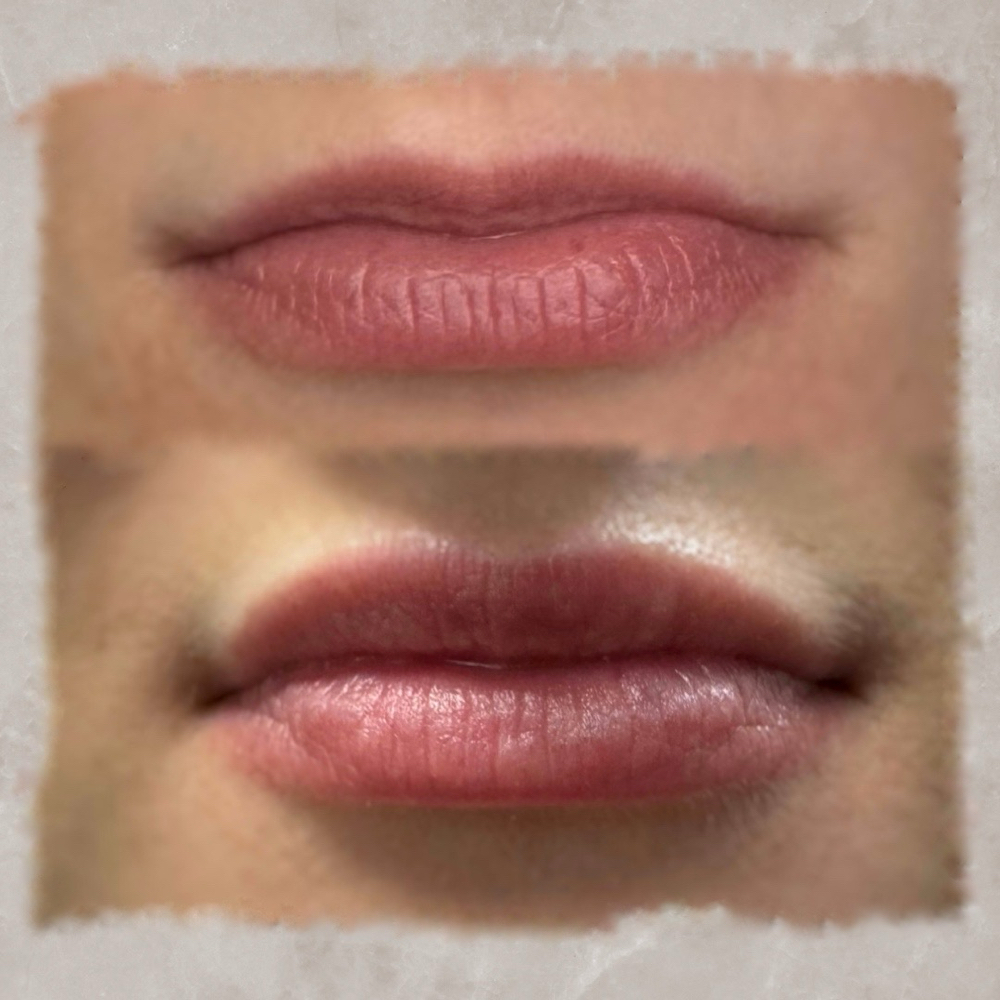 2ml Lip Filler