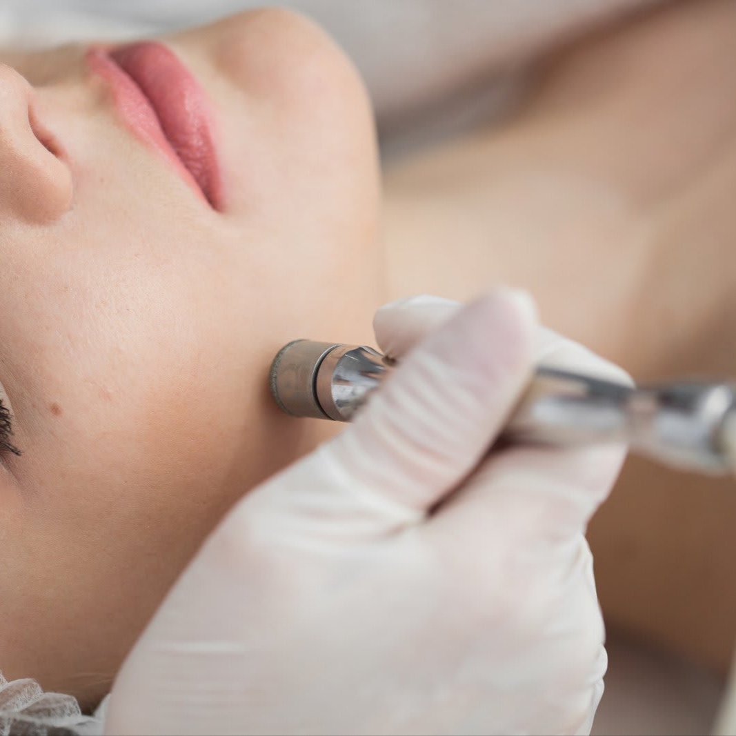Microdermabrasion Facial