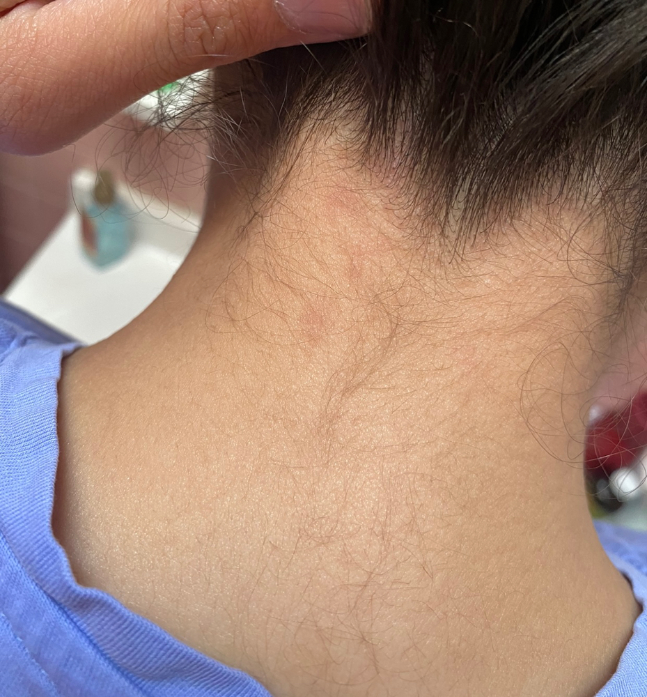 Nape (Back Of Neck)