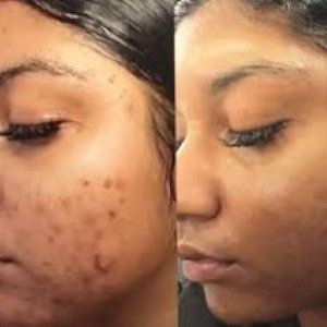 30% Glycolic Peel at Be Beautiful Esthetics in Cleburne, TX