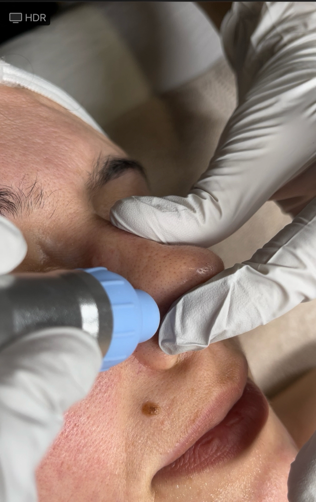 Hydrodermabrasion Facial