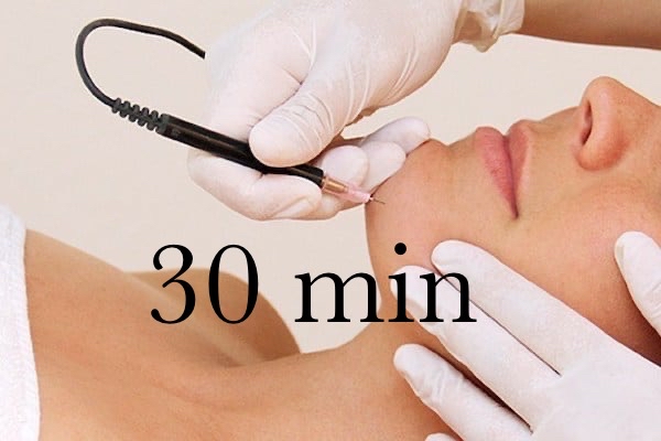 30 Minute Electrolysis Treatment