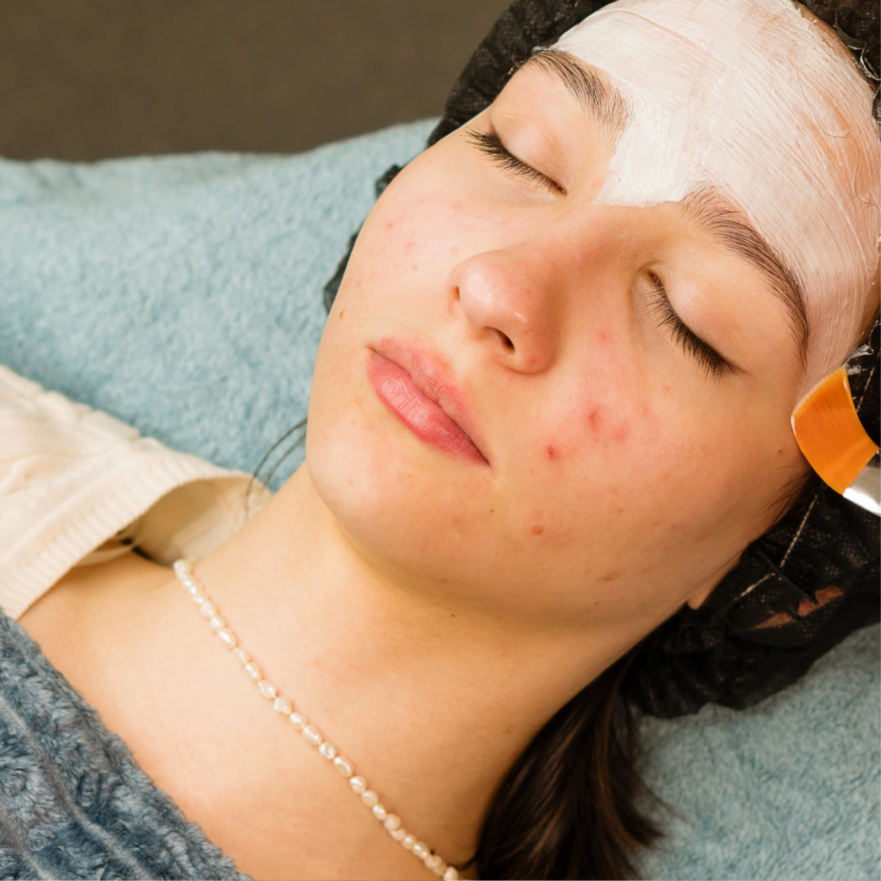 Clarity Peel | Acne & Texture at Arcana Med Spa in Castle Rock, CO