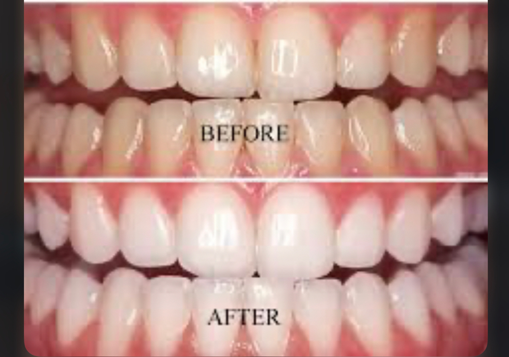 Teeth Whitening at 143Aesthetics_ in Washington, DC