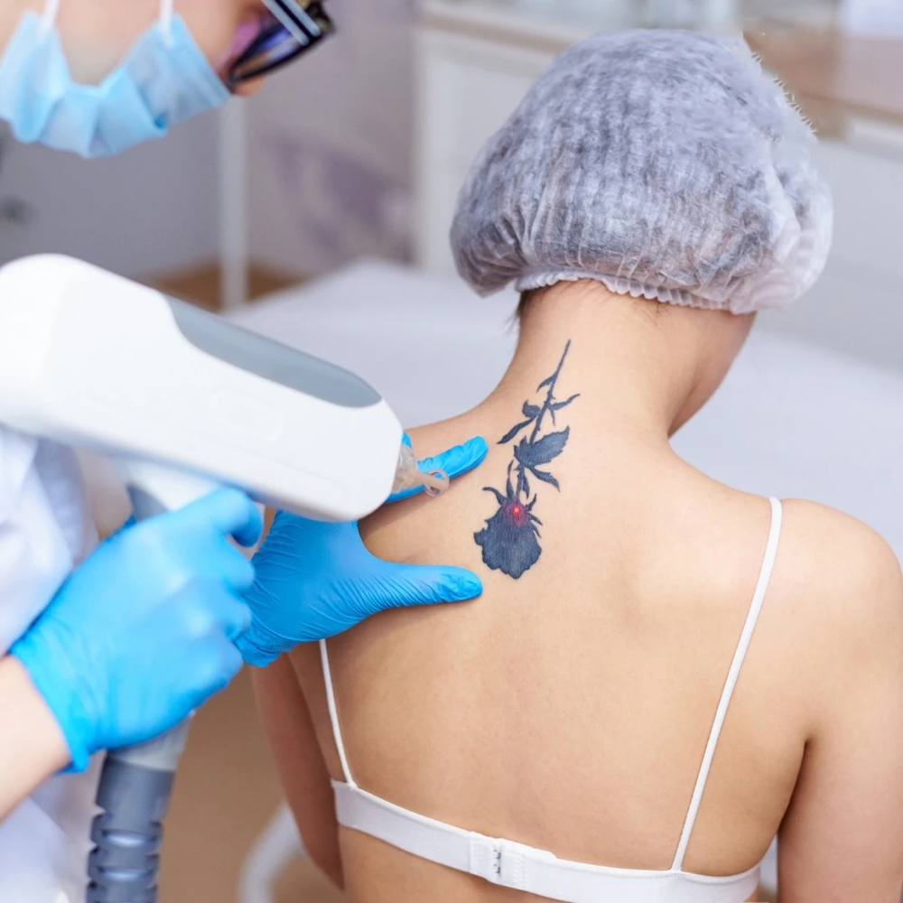 Tattoo Removal