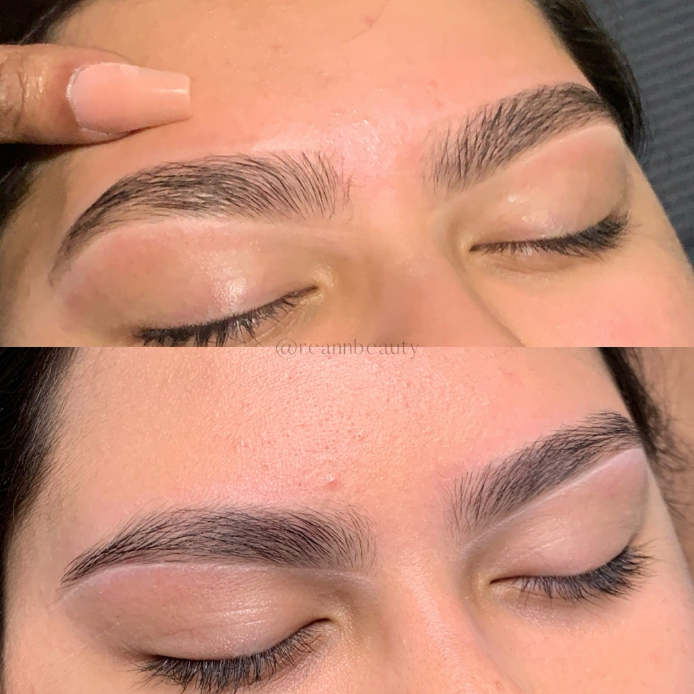 Brow Rehabilitation