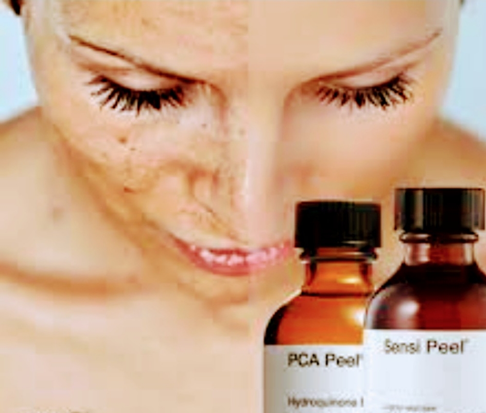 Chemical Peel