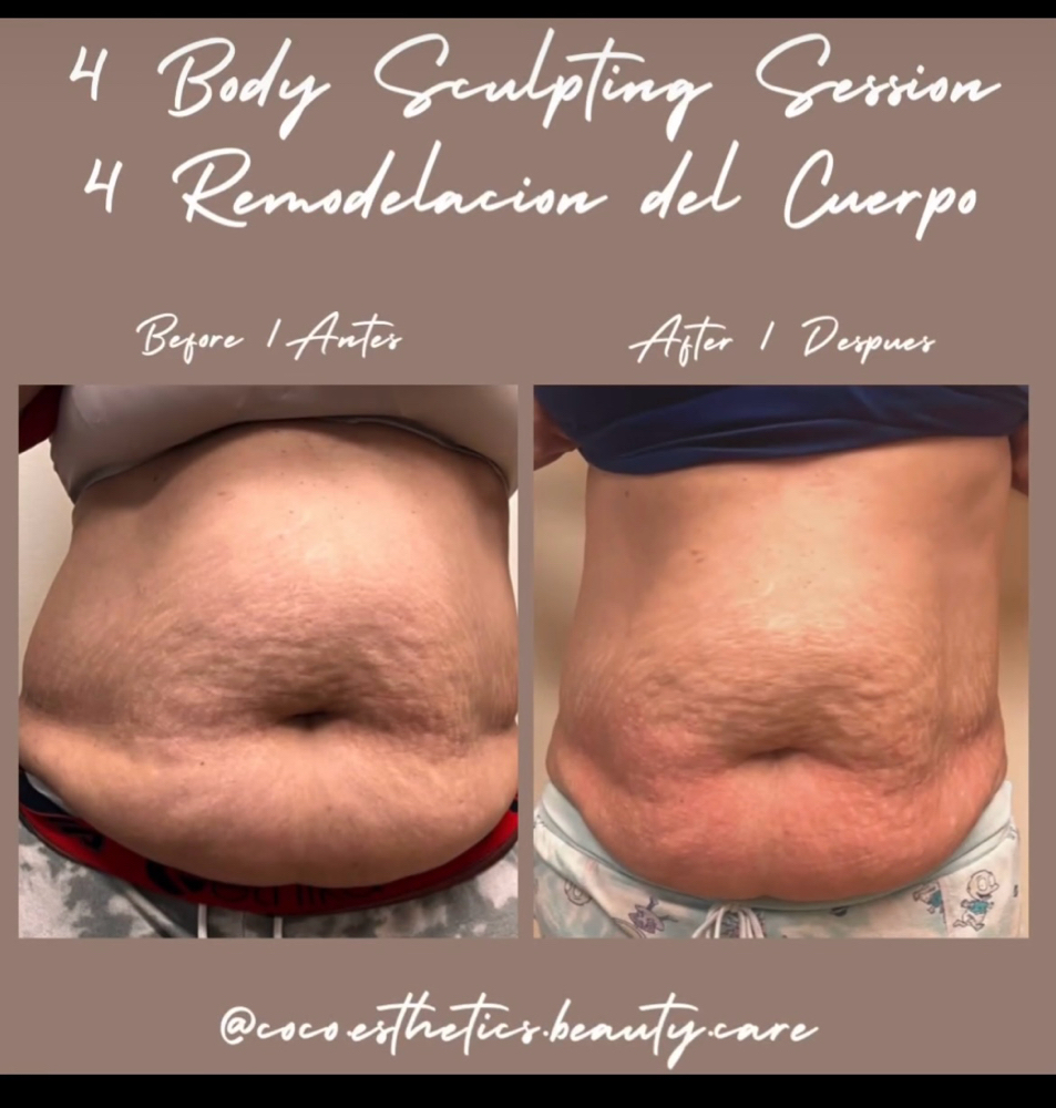 Abdomen Sculpting