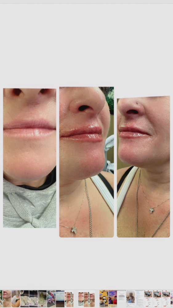 Lip Enhancements 1ml