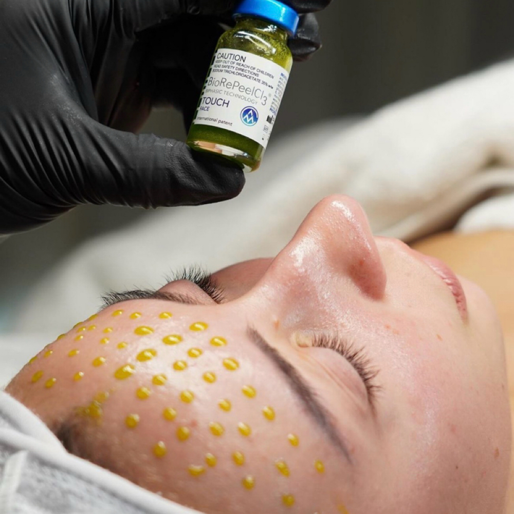 BioRePeel Treatment at Skincare By Liliya in Sherman Oaks, CA