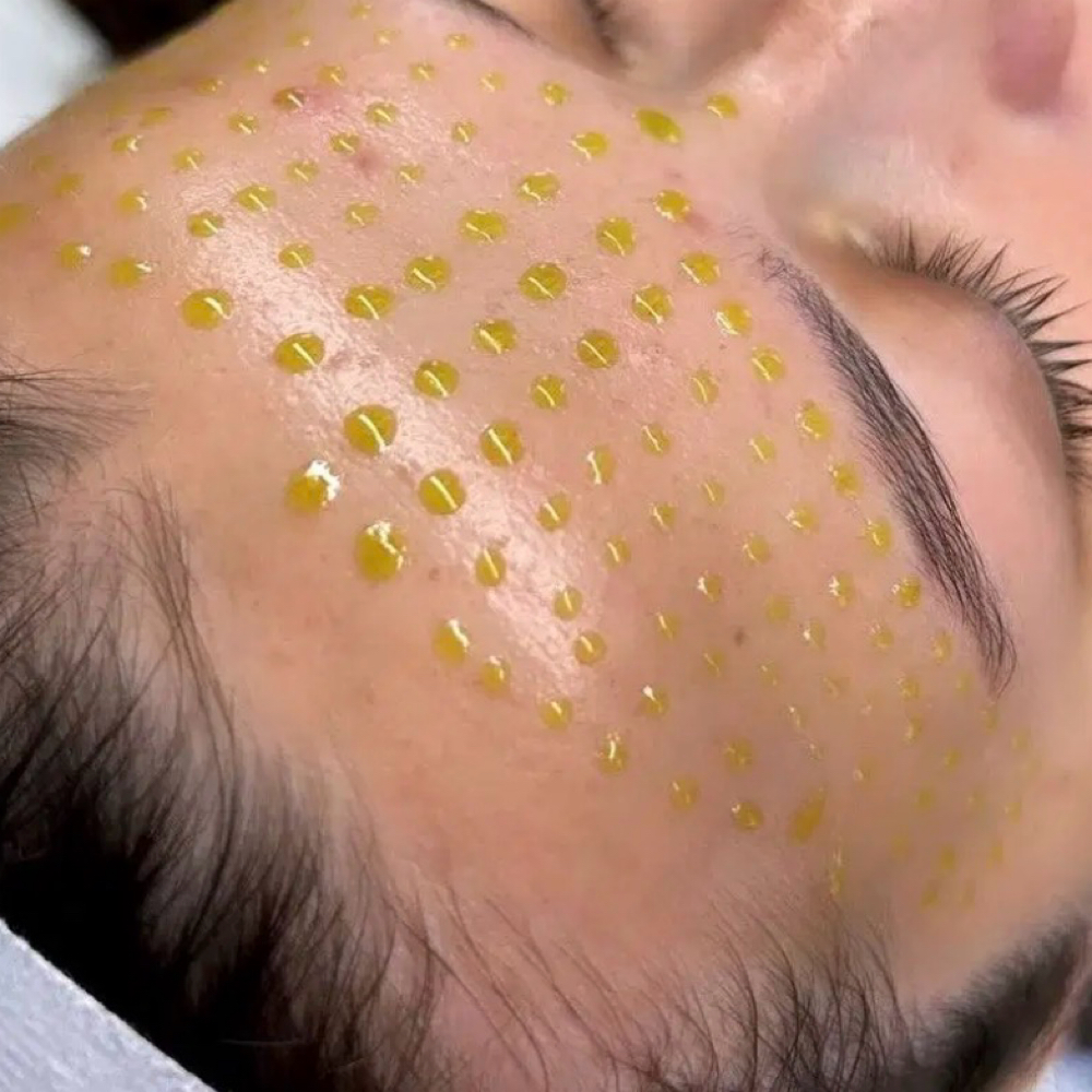 BioRePeel + Dermaplaning at Alira Aesthetics in Mcallen, TX