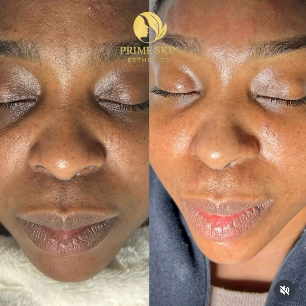 SQT Hyperpigmentation Facial at Prime Skin  Esthetics in Belleville, NJ
