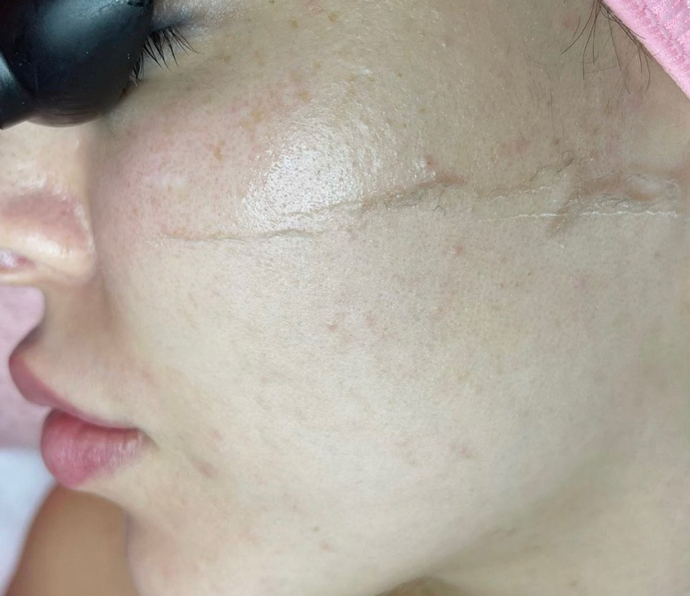 Dermaplane W/ OXYGEN INFUSION