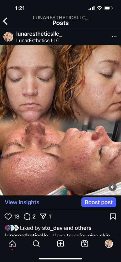 Acne Consult+Treatment (in Clinic)