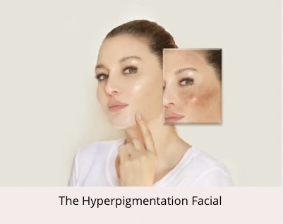 Hyperpigmentation Facial