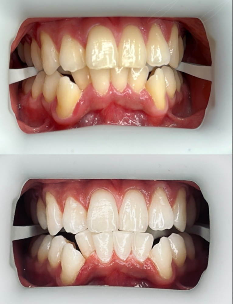 Teeth Whitening at Rohi Nails & Spa LLC. in Tucson, AZ