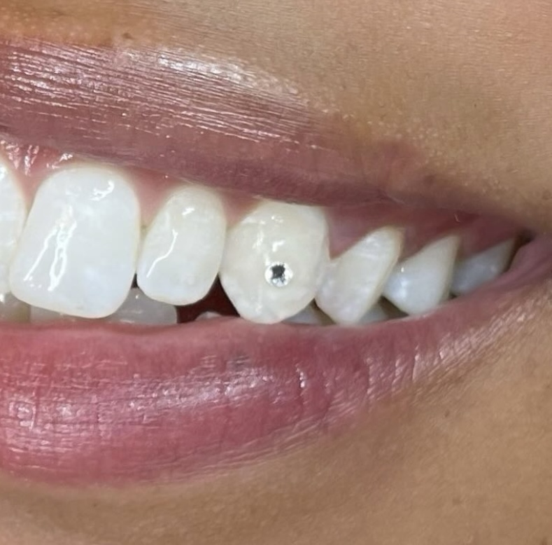Tooth Gem Application