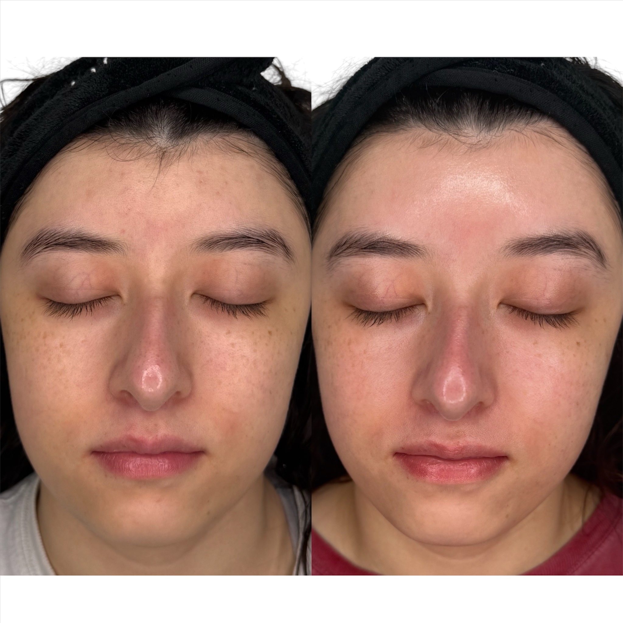 SkinPen + PDRN + GHK-Cu + LED at Skin Corrective Aesthetics in Dallas, TX