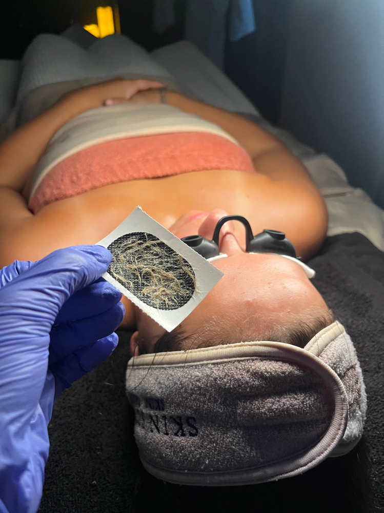 Dermaplane Facial