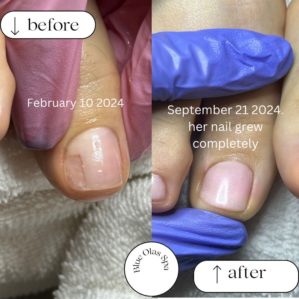 Toe Nail Reconstruction Pedicure