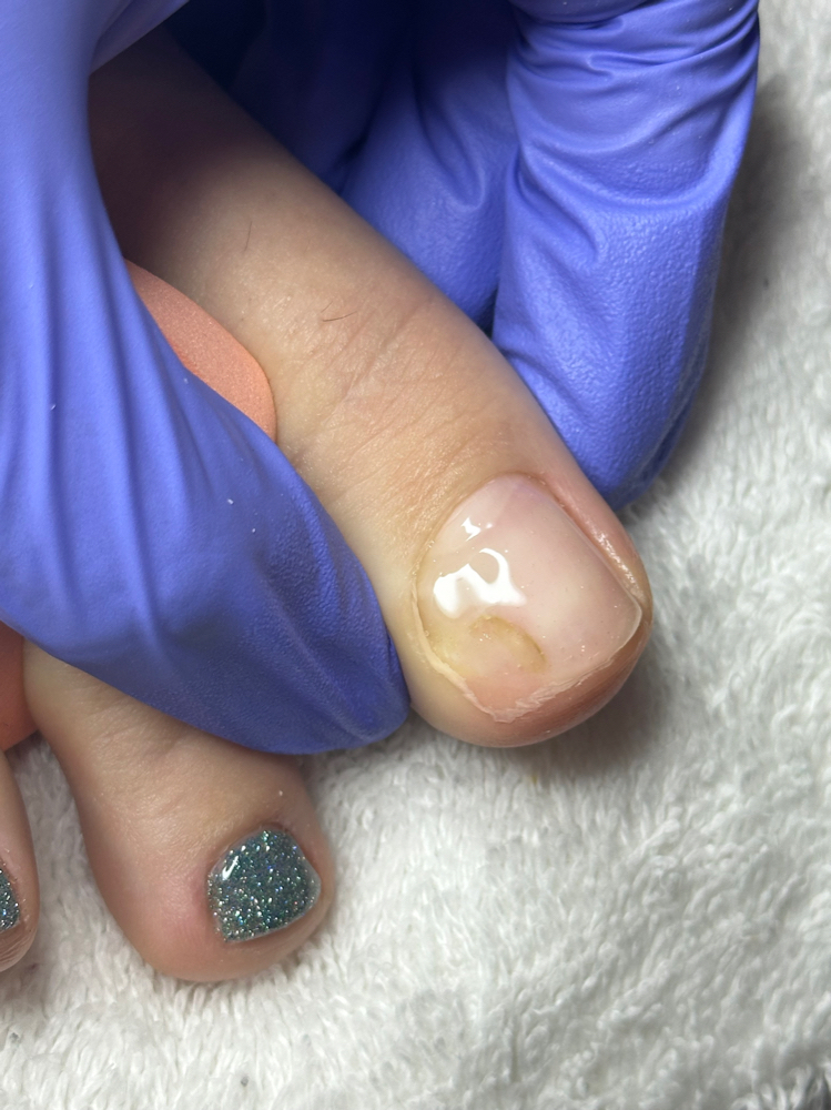 Toe Nail Reconstruction Pedicure