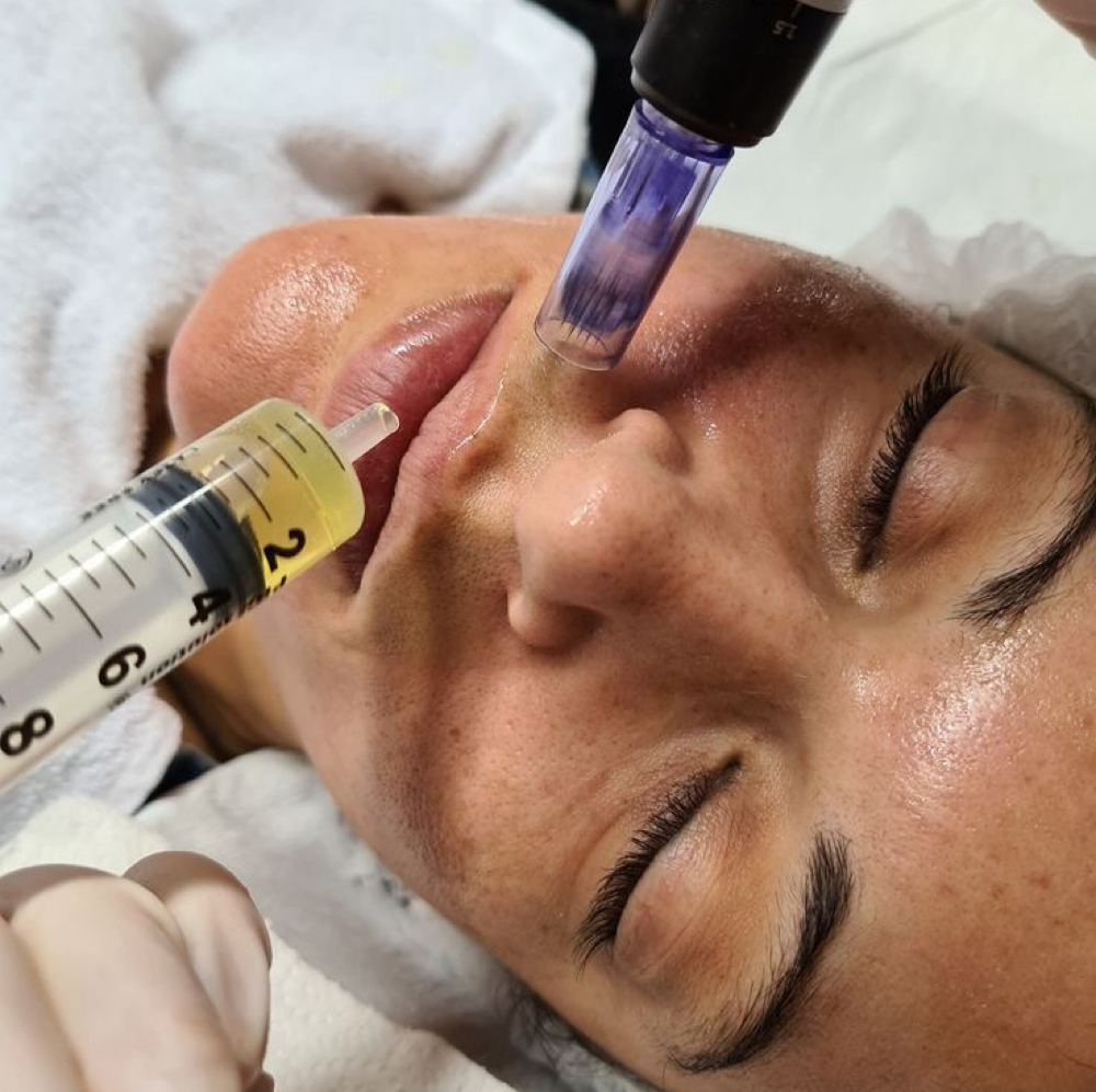 PRP Facial at Vanessa Yarce in Miami, FL