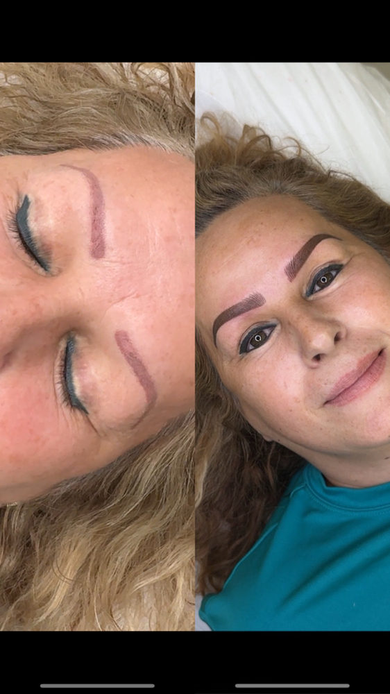 Correction Of Brows