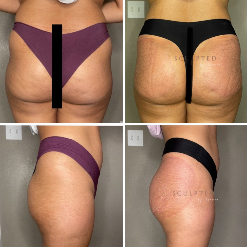 Booty Lift 3 Session Special at Sculpted by Lluvia in Weslaco, TX
