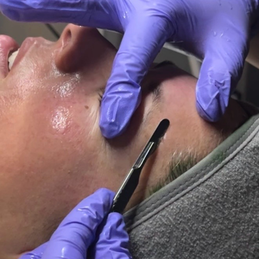 Add On - Dermaplane at Daily SkinTual in California, CA