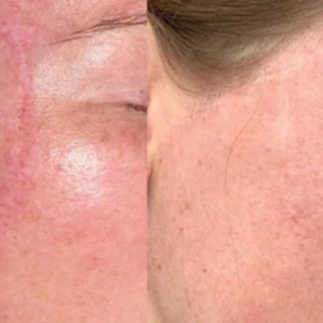 SCAR REVISION SESSION [MED SCARS] at GloVolution LLC in Homosassa, FL