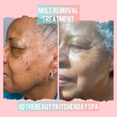 DPN/Skin Tag Removal Treatment