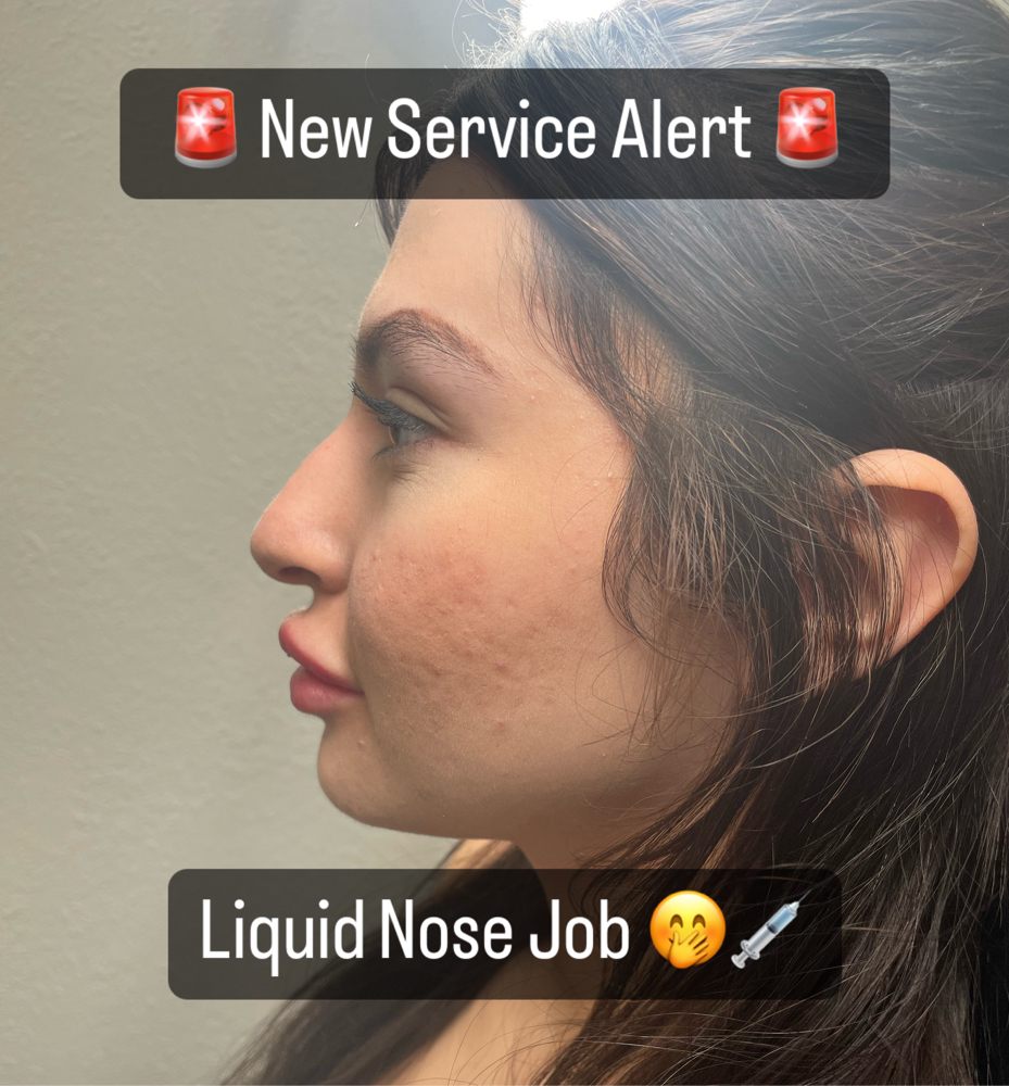 Liquid Rhinoplasty