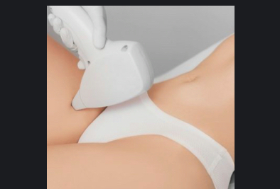 Bikini Line Laser