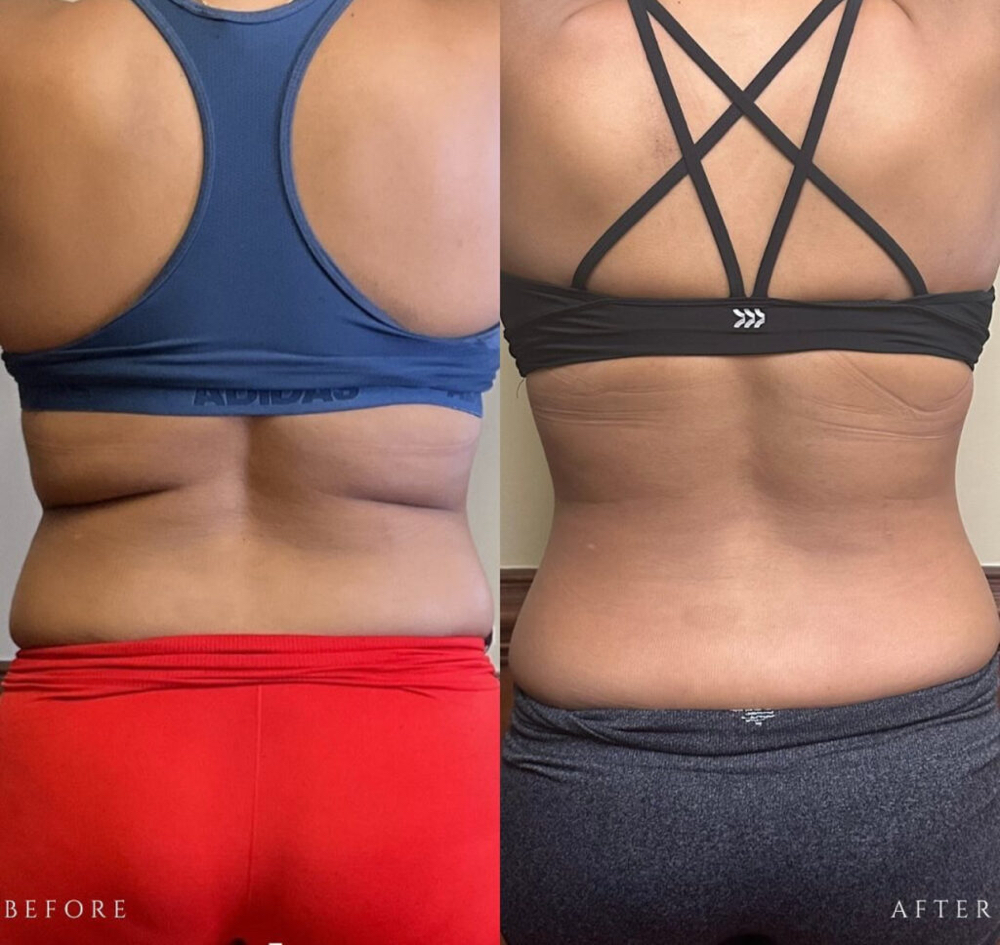 Body Fat Reduction-PCDC