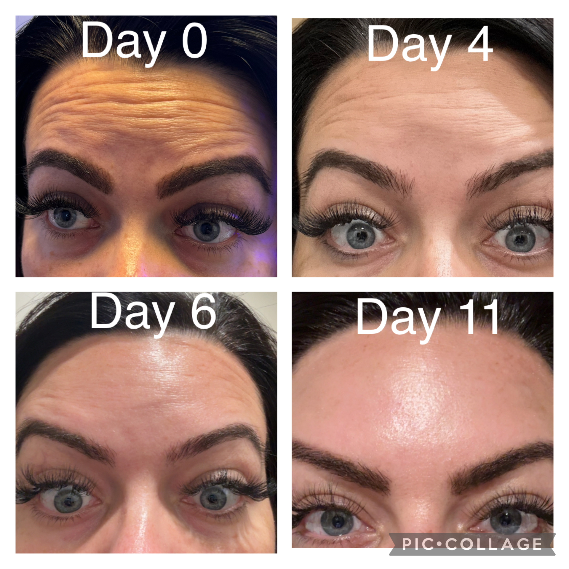 Botox