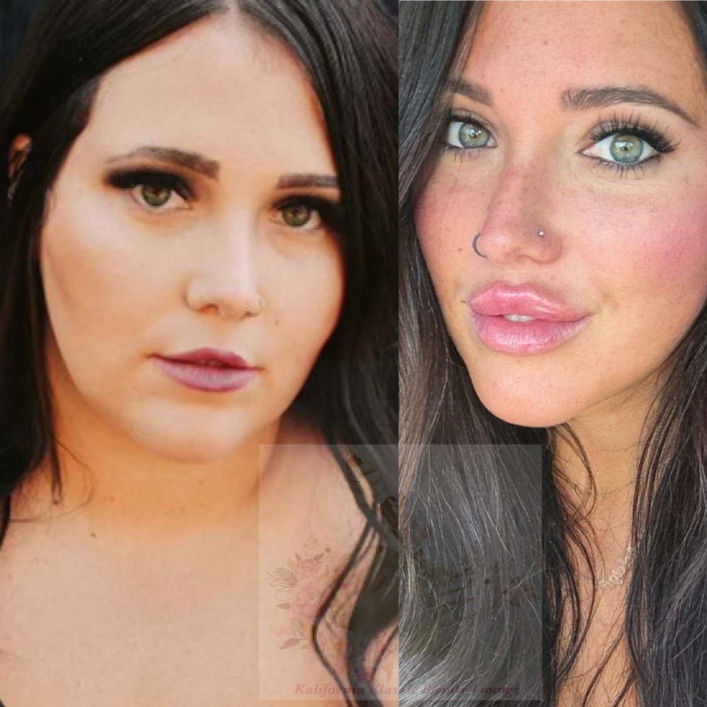 Hya Platinum 12 Month Infusion at Kalifornia Klassic Beauty Lounge in Warr Acres, OK