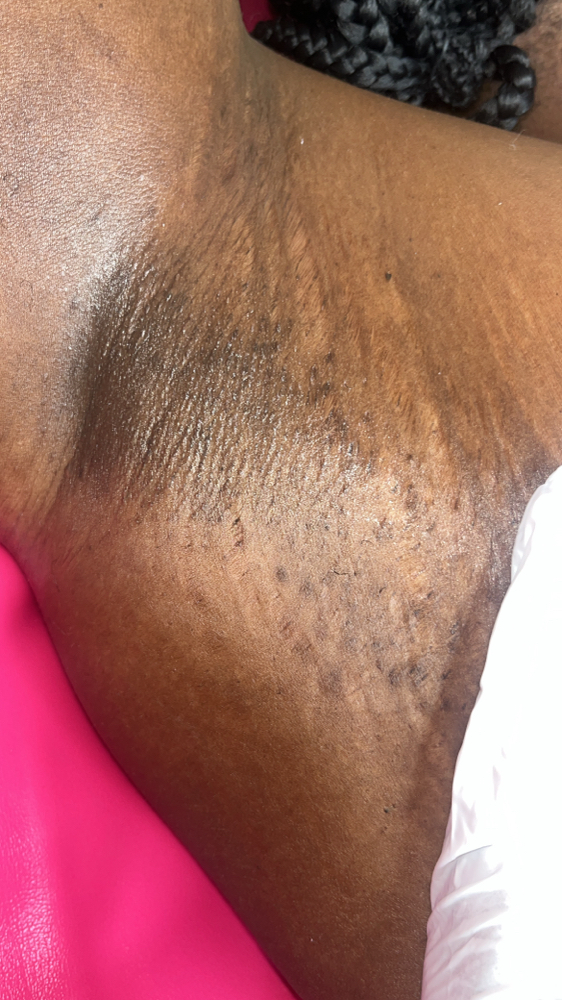 Underarm