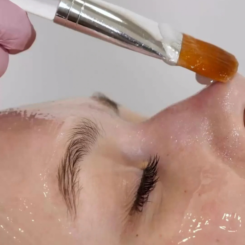 Custom Facial & Sun Damage Peel at A.L aesthetics in Dawsonville, GA