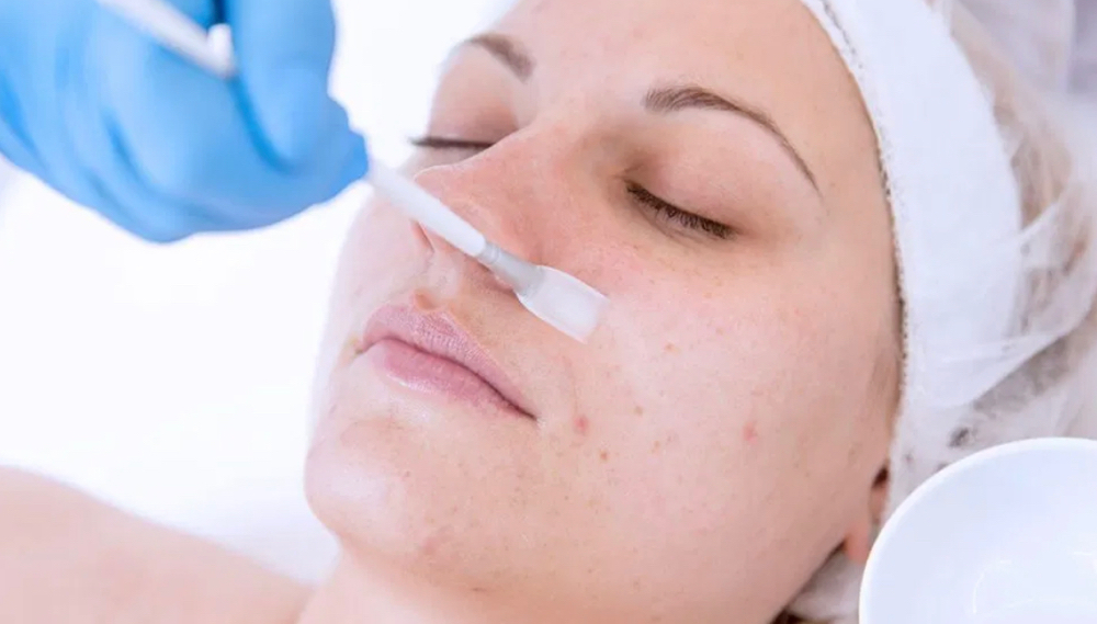 Superficial To Mid Chemical Peel