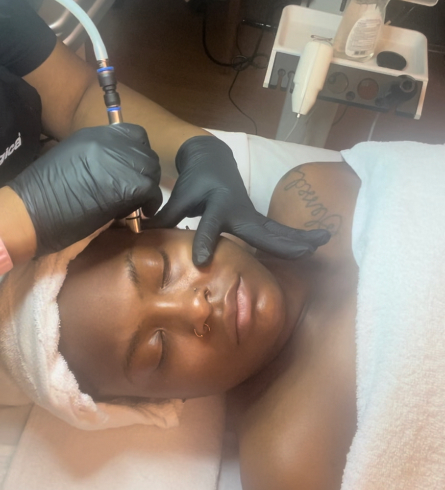 Microdermabrasion ADD ON