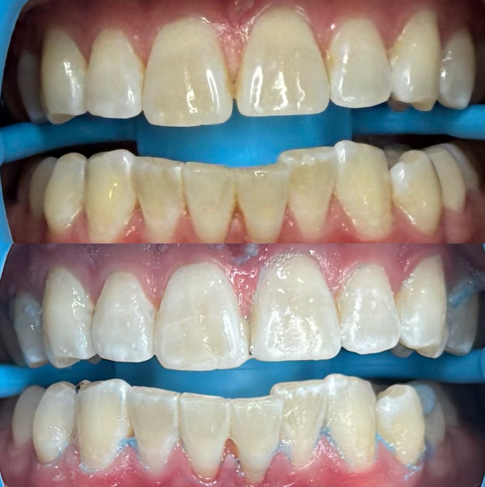 Solo Whitening at Bright White Co. in Crosslake, MN