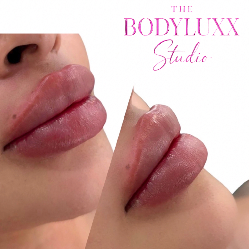 1 ml Lip Filler (Needle) at Thebodyluxxstudio in Lubbock, TX