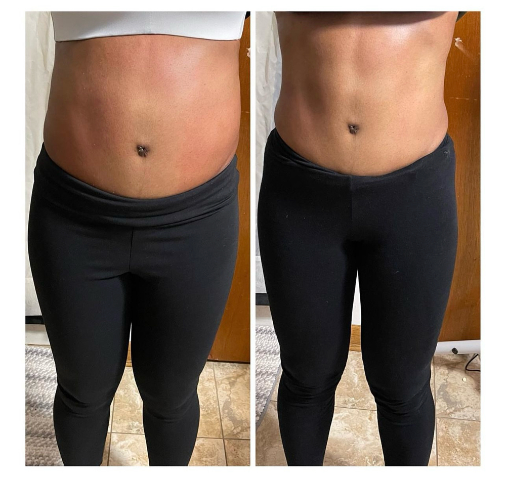 Glp1 Tirzepatide First Month