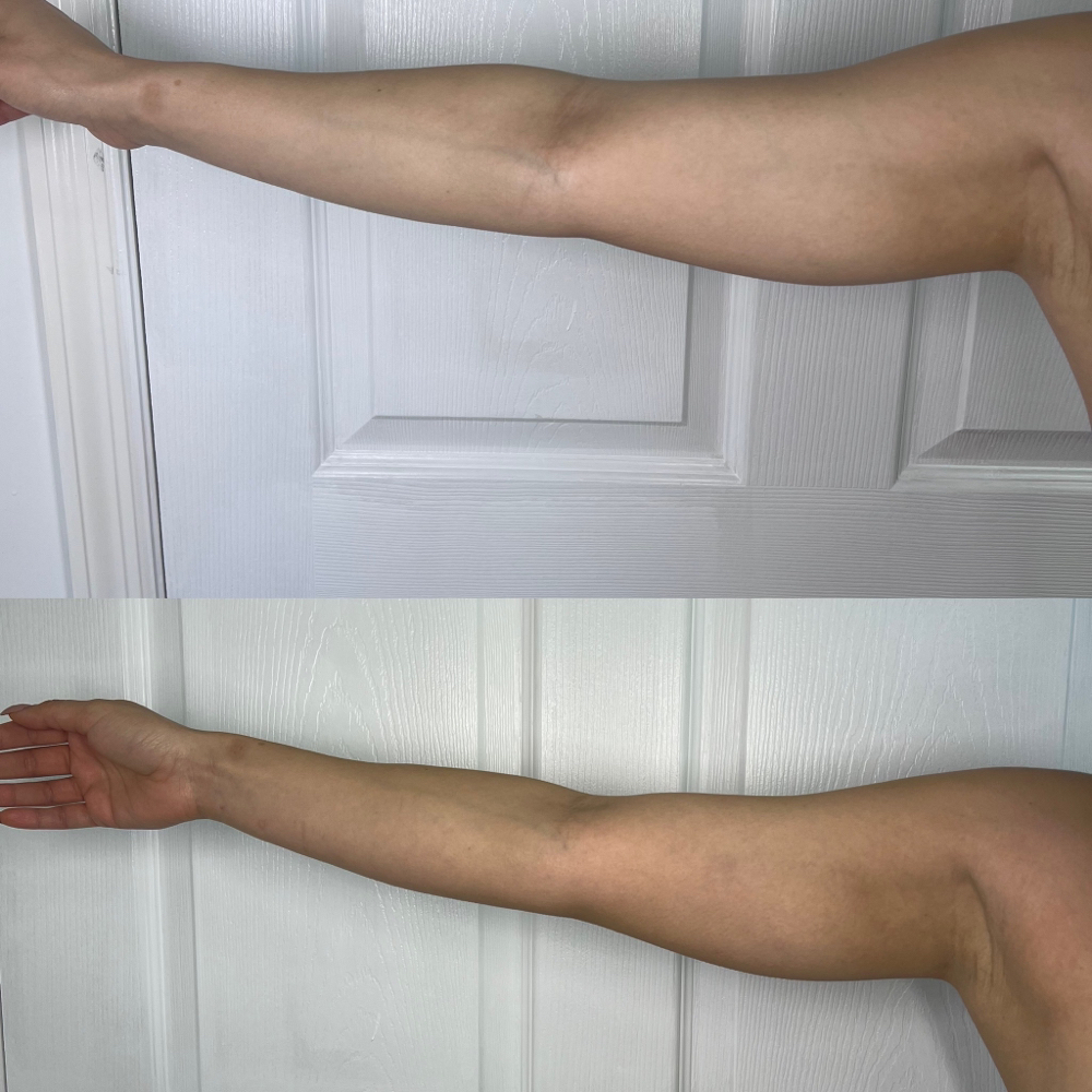 8 Arm Slimming & Tightening Session