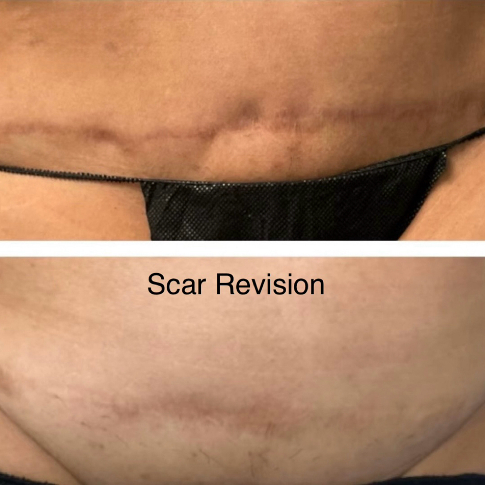 Inkless Treatment For Scars at Flawless Skin By Sarah in Roseville, CA